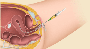 Embryo Transfer